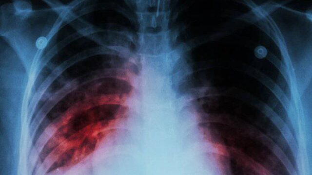 Εθνικός Οργανισμός Δημόσιας Υγείας: Η φυματίωση είναι εδώ