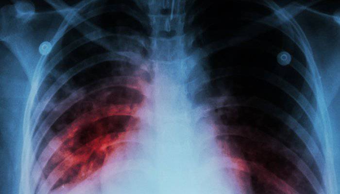Εθνικός Οργανισμός Δημόσιας Υγείας: Η φυματίωση είναι εδώ