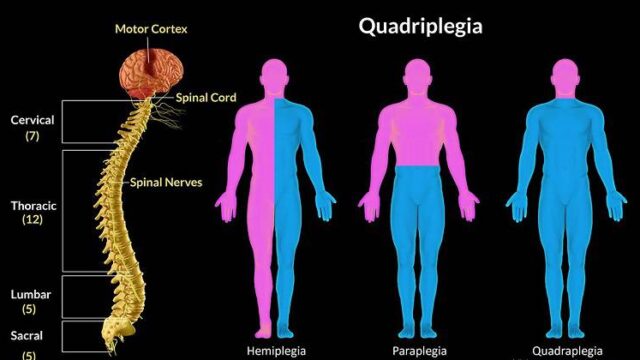 Αποκατάσταση λειτουργίας των άνω άκρων σε τετραπληγικούς