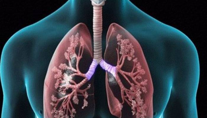 Κορονοϊος: Τι πρέπει να προσέχουν οι ασθενείς με άσθμα και ΧΑΠ