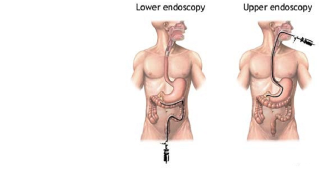 Κολονοσκόπηση και γαστροσκόπηση: Τι είναι και πότε πρέπει να γίνονται
