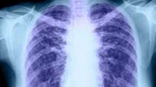 Τι συμβαίνει με την “πνευμονία στην Κίνα”