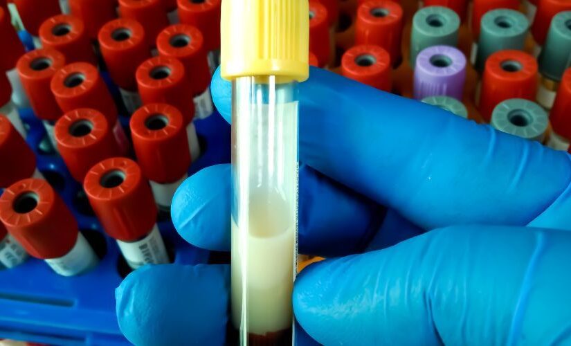 Παίζει ρόλο η διατροφή στο λιποίδημα; Μαρία Παναγιωτίδου