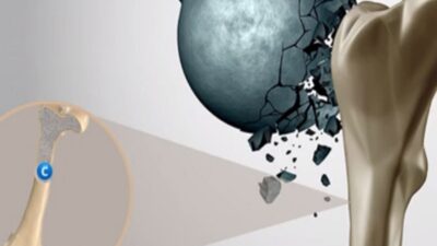 Για καλύτερη Οστική Υγεία δεν αρκεί μόνο η διατροφή