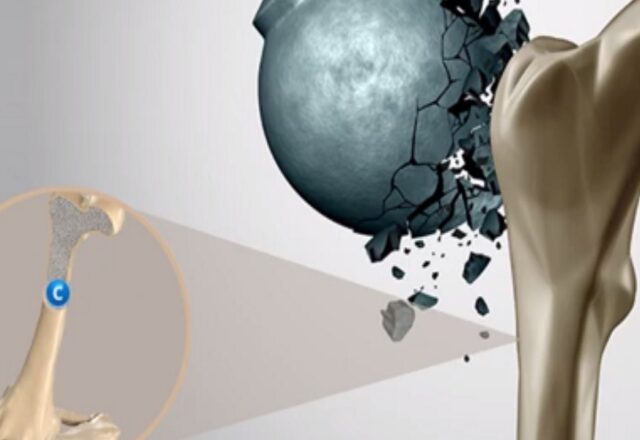 Για καλύτερη Οστική Υγεία δεν αρκεί μόνο η διατροφή