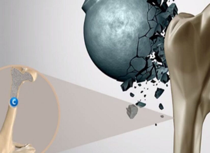 Για καλύτερη Οστική Υγεία δεν αρκεί μόνο η διατροφή